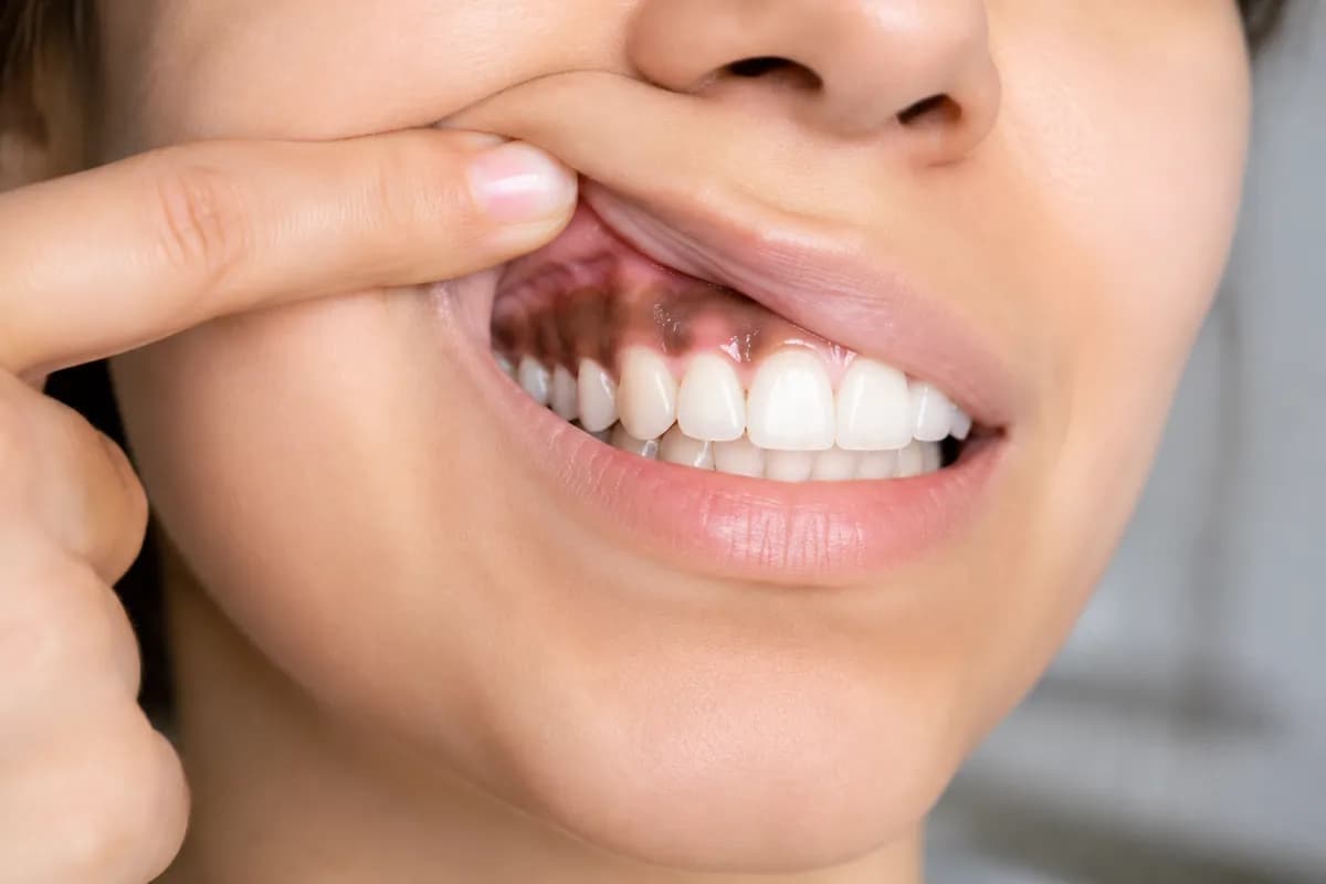 Gum color change; is it normal or should we be worried?